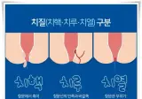 우리나라 사람들 10명중 3명은 하게된다는 수술