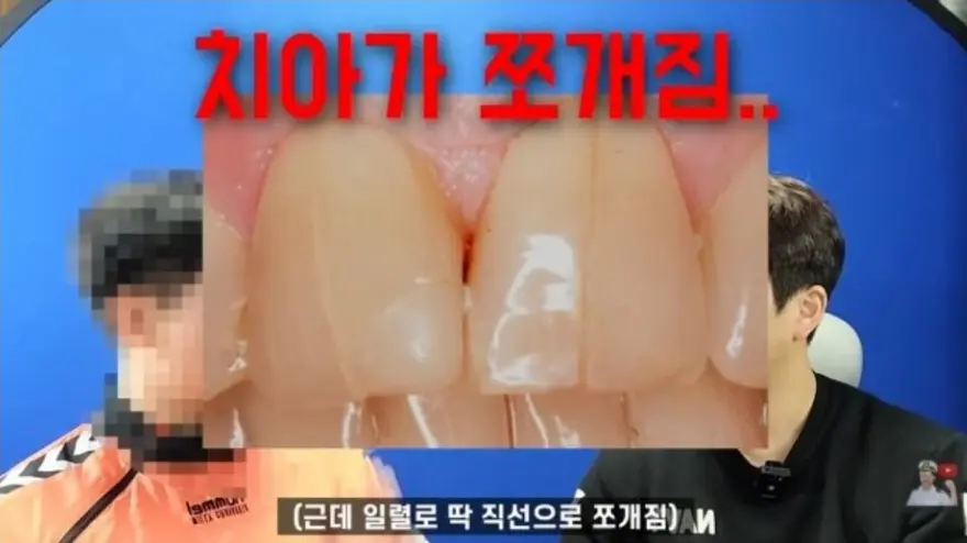 치아 쪼개짐.png