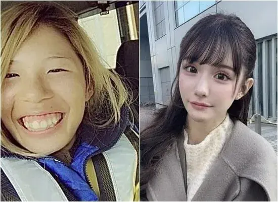 8411.jpg 2억원치 성형결과