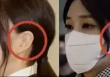 귀 성형 엄청 아프다던데