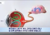 국내연구진 우울증 치료용 렌즈 개발 🇰🇷