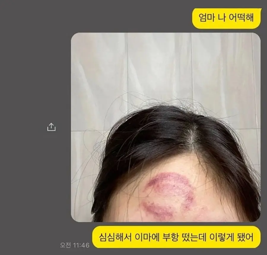 머리에 부황뜬 딸이 한심했던 어머니.JPG