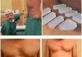 인공 복근 수술