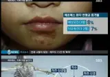 헤르페스가 완치가 불가능한 이유