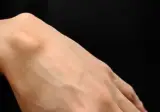 손목결절종 치료 후기.twit
