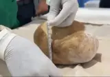 방광결석 3.1kg