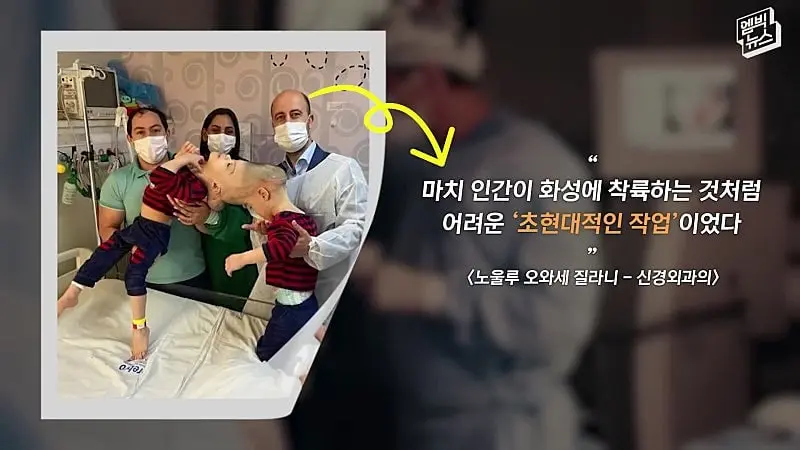 33시간 수술 끝에 얼굴 본 쌍둥이.jpg