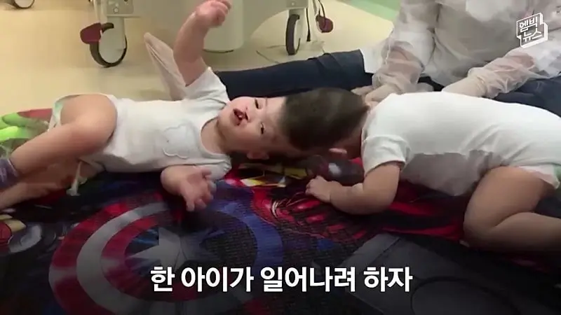 33시간 수술 끝에 얼굴 본 쌍둥이.jpg