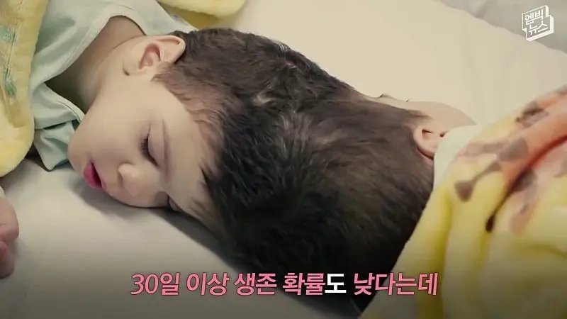 33시간 수술 끝에 얼굴 본 쌍둥이.jpg