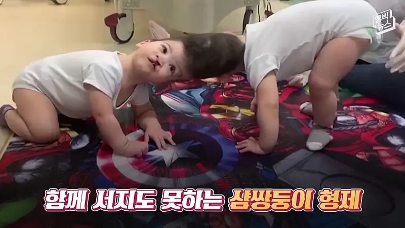 33시간 수술 끝에 얼굴 본 쌍둥이.jpg