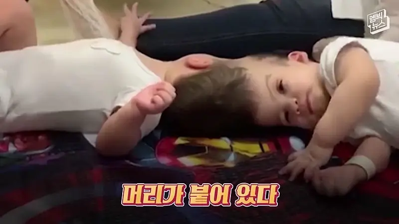 33시간 수술 끝에 얼굴 본 쌍둥이.jpg