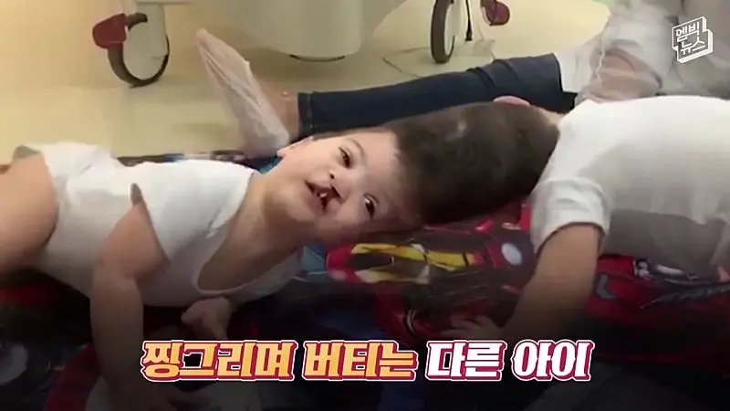 33시간 수술 끝에 얼굴 본 쌍둥이.jpg