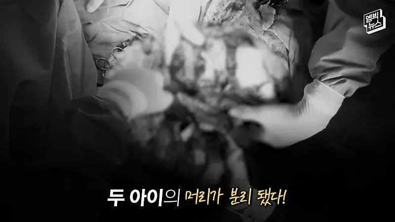 33시간 수술 끝에 얼굴 본 쌍둥이.jpg