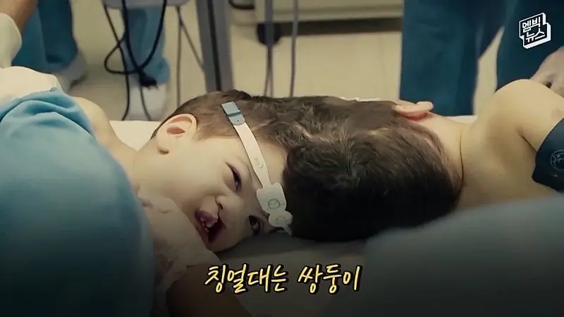 33시간 수술 끝에 얼굴 본 쌍둥이.jpg