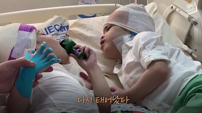 33시간 수술 끝에 얼굴 본 쌍둥이.jpg