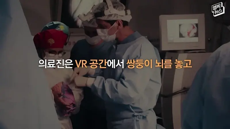 33시간 수술 끝에 얼굴 본 쌍둥이.jpg