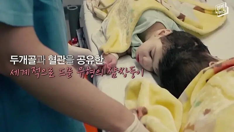 33시간 수술 끝에 얼굴 본 쌍둥이.jpg