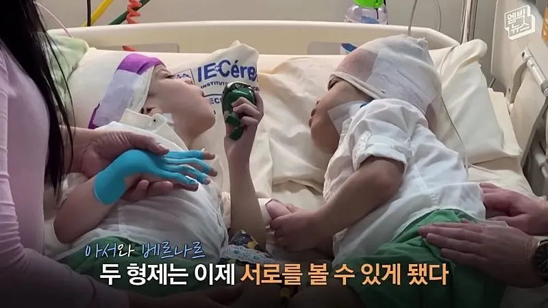 33시간 수술 끝에 얼굴 본 쌍둥이.jpg