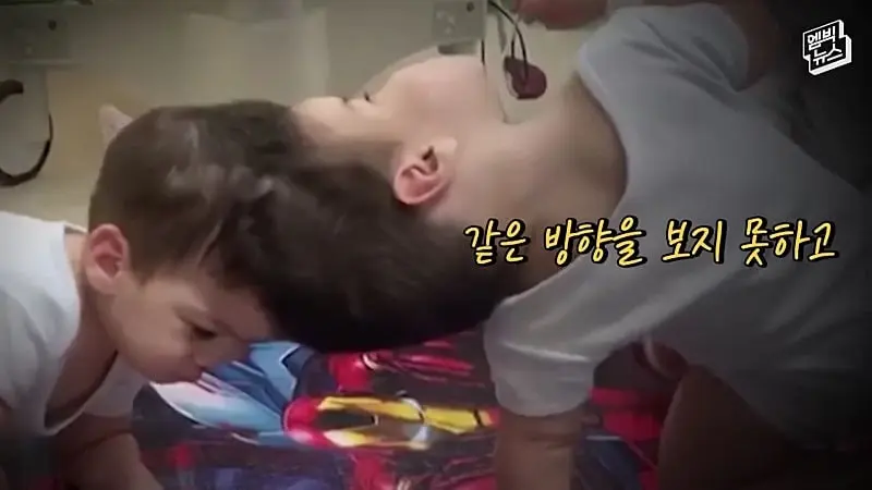 33시간 수술 끝에 얼굴 본 쌍둥이.jpg