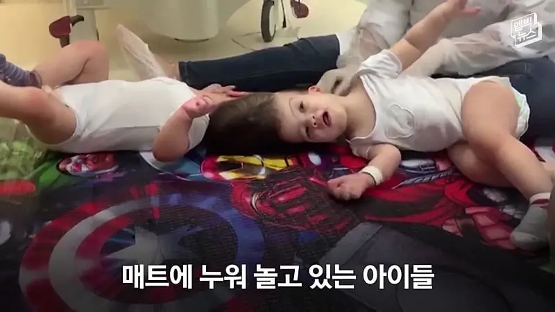 33시간 수술 끝에 얼굴 본 쌍둥이.jpg