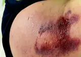 아빠한테 피멍들도록 맞은 딸래미.jpg