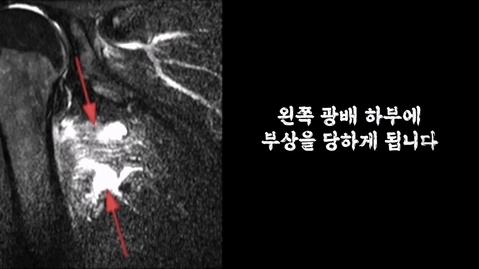 3674일 동안 운동에 모든 걸 쏟으면 생기는 몸의 변화_20260911_195439.000.jpg