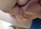 (혐) 사마귀를 통째로 뽑은 놈