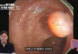혐주의) 하지만 알아두면 좋은) 대장 용종 제거 영상 ㄷㄷㄷㄷ;;