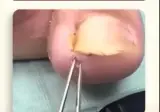 (혐) 관통형 내성발톱