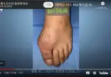 몸에서 탕수육을 생산하는 통풍환자 수술