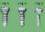 뼈에 박는 나사 근황 ㄷㄷ..jpg