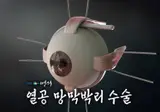 안구 수술중 가장 난이도 높다는 수술