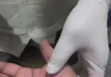 손바닥에 낀 낭종 제거.GIF