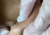 거대 피지낭종 제거 장면